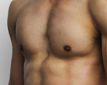 Gynecomastia Surgery
